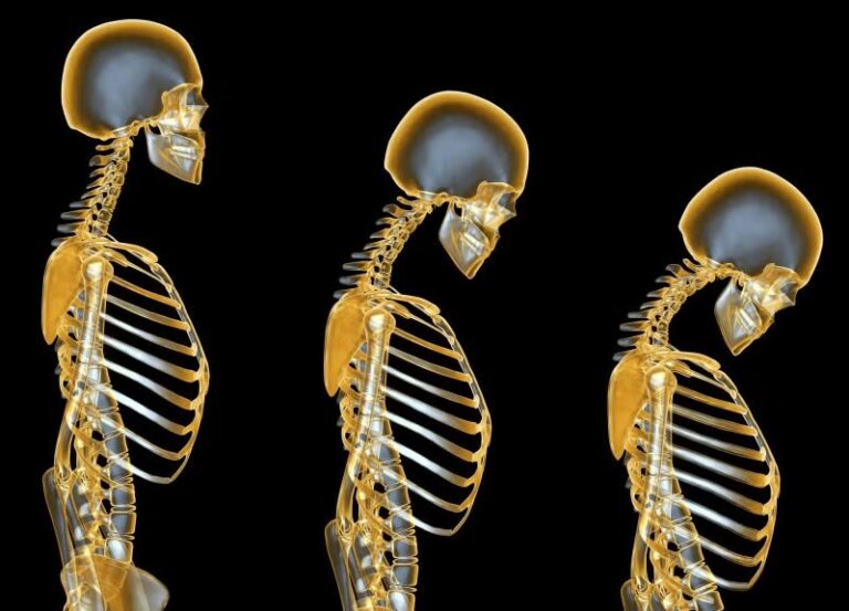 La importancia de la detección y prevención temprana de la osteoporosis